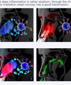 Infrared Rhinitis Therapy Device