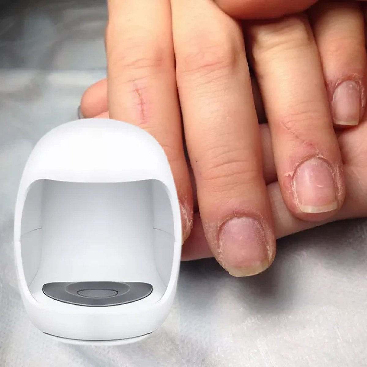 antifungal laser device 1